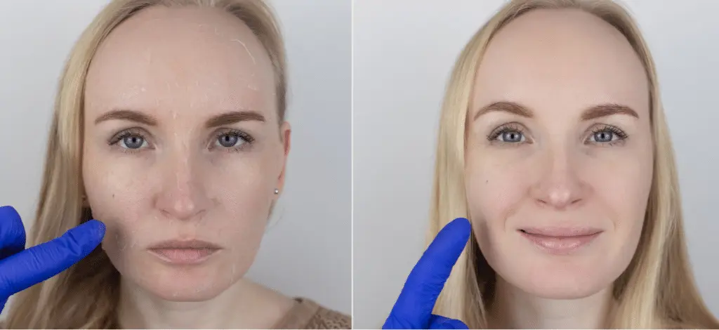Woman’s face before and after anti-aging facial treatment with reduced fine lines.
