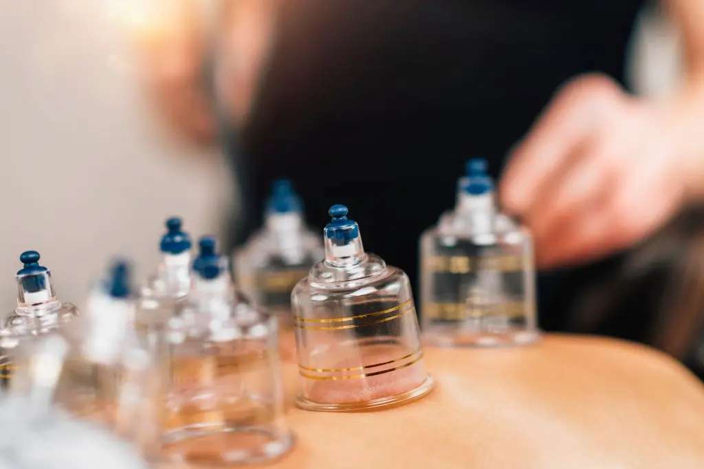 Cupping therapy treatment improving blood circulation for back pain