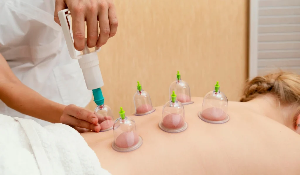 Cupping therapy