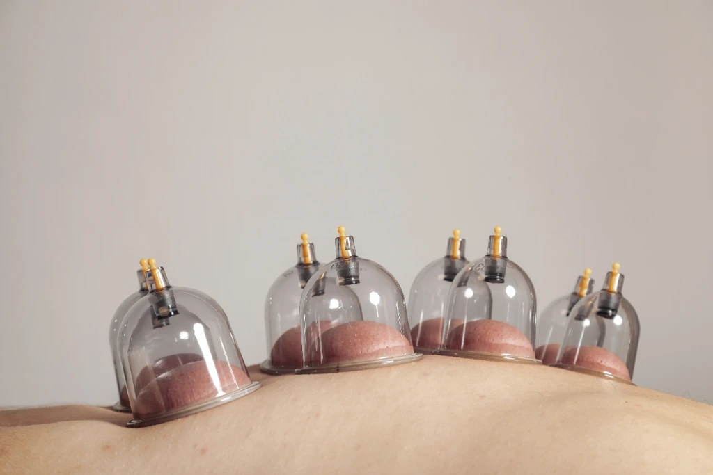 cupping therapy