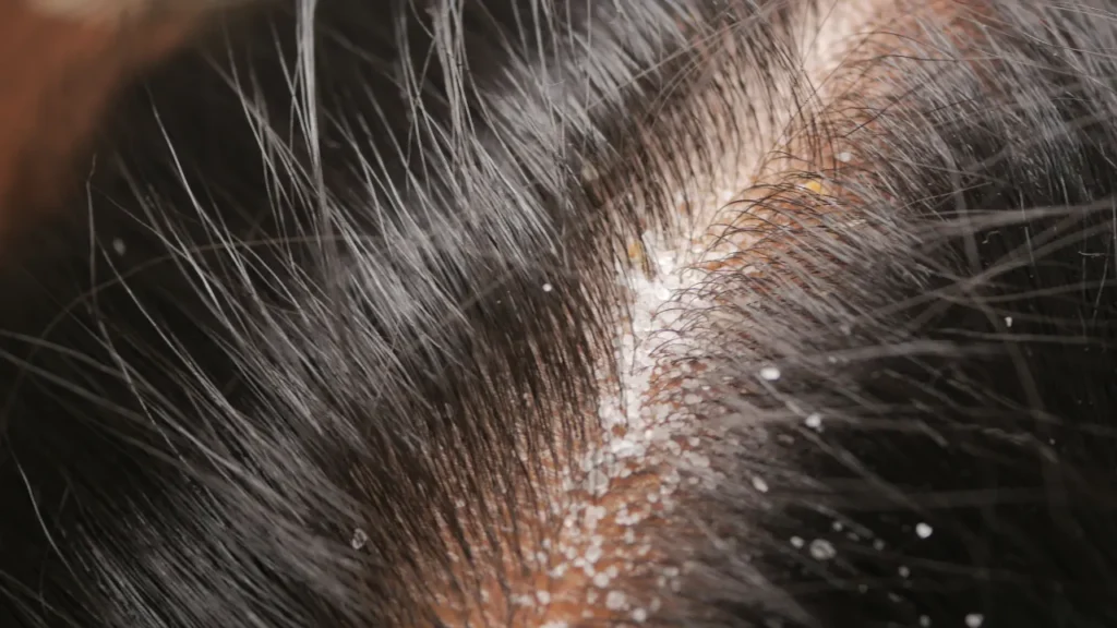 hair dandroff