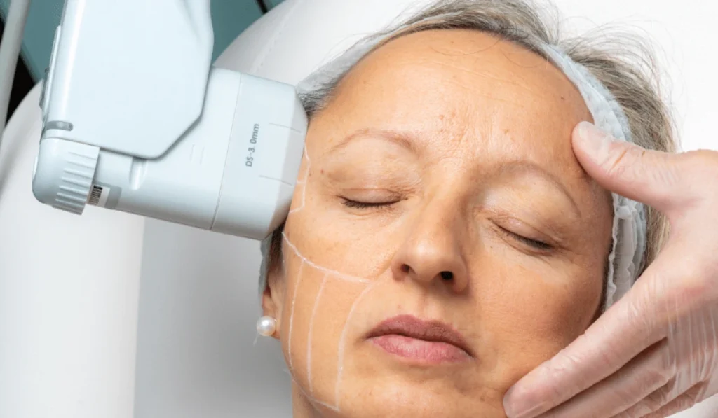 Aging skin being treated with a medical device on a mature woman's face. Lines are visible on her skin, and a gloved hand provides support.