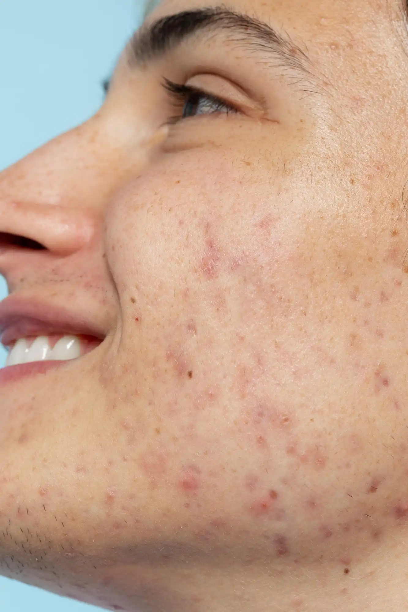 Acne prone skin